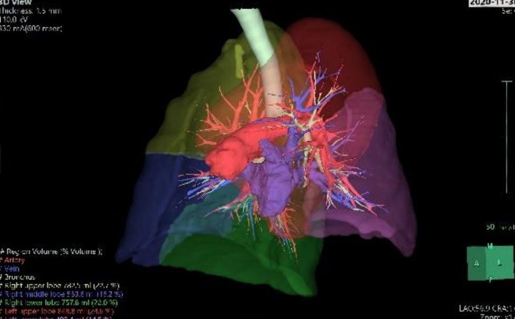 3D reconstruction of the CT scan depicting Mr. Cheng's lungs